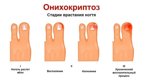Štádiá onychokryptózy pri zarastaní nechtov